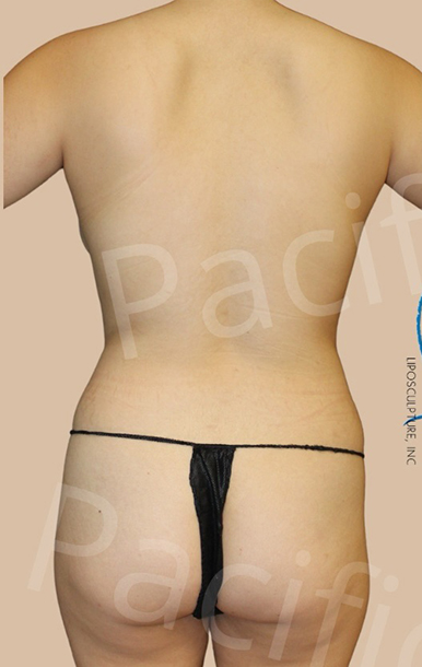 Procedure before and after - before