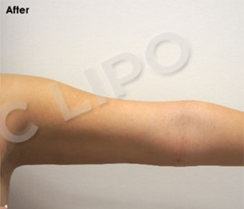 Procedure before and after - before