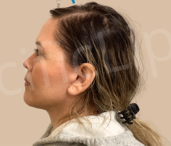 Procedure before and after - after