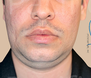 Procedure before and after - before