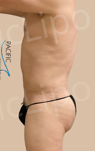 Procedure before and after - after