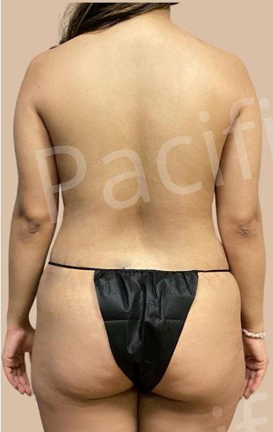 Procedure before and after - before