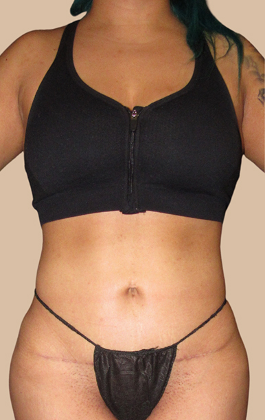 Procedure before and after - after
