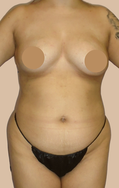 Procedure before and after - before