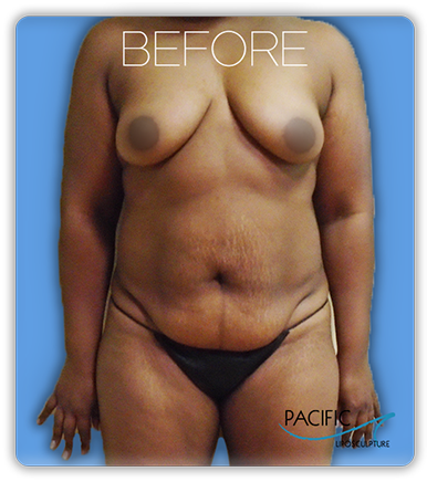 Procedure before and after - before