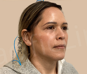 Procedure before and after - after