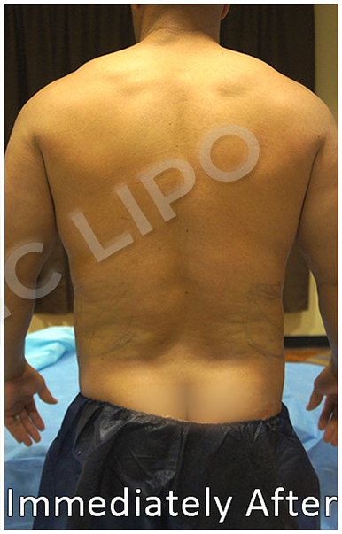 Procedure before and after - before