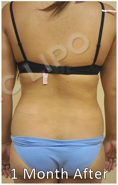 Procedure before and after - before