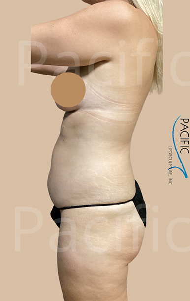 Procedure before and after - before