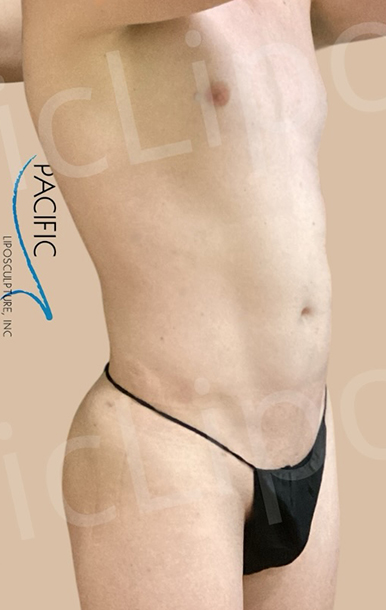 Procedure before and after - after