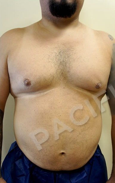 Procedure before and after - before