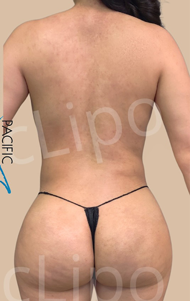 Procedure before and after - after
