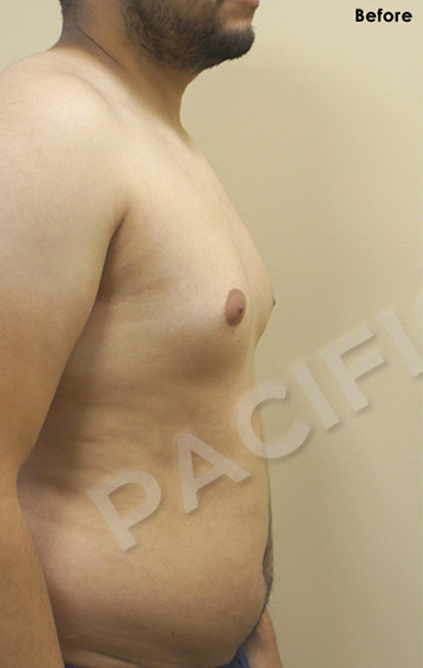 Procedure before and after - before
