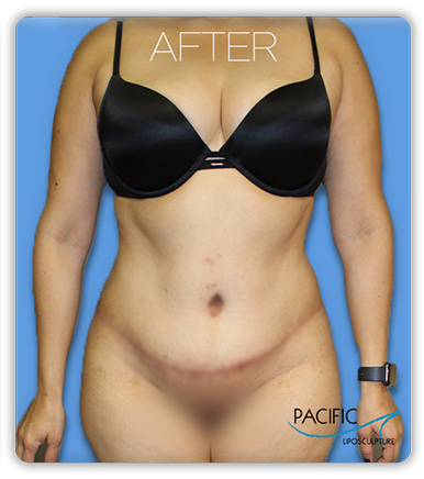 Procedure before and after - after