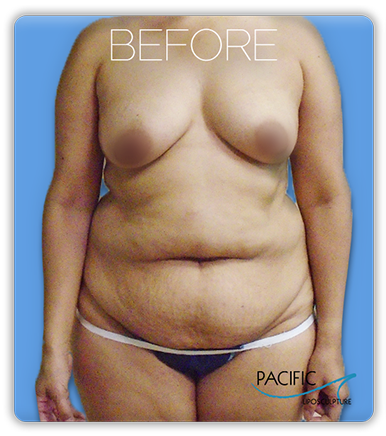Procedure before and after - before