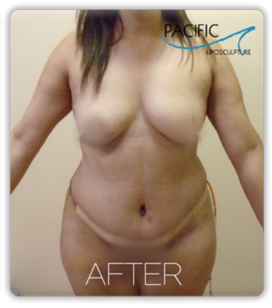 Procedure before and after - after