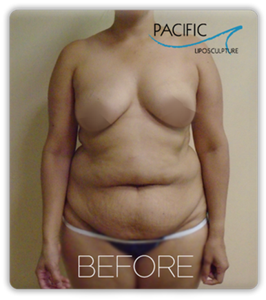 Procedure before and after - before