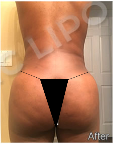 Procedure before and after - after
