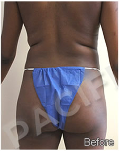 Procedure before and after - before
