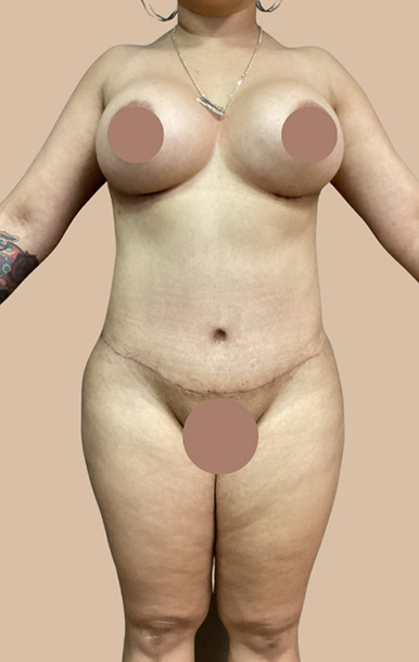 Procedure before and after - after