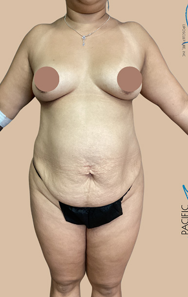Procedure before and after - before