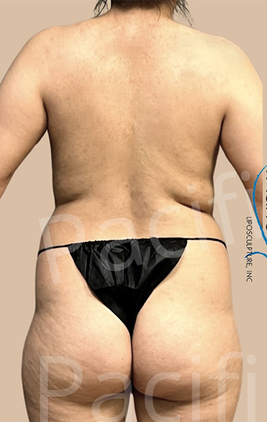 Procedure before and after - before