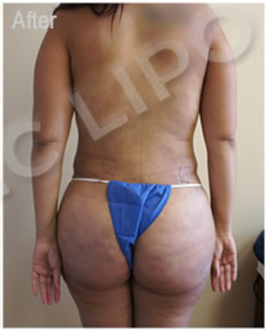 Procedure before and after - after