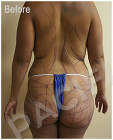 Procedure before and after - before