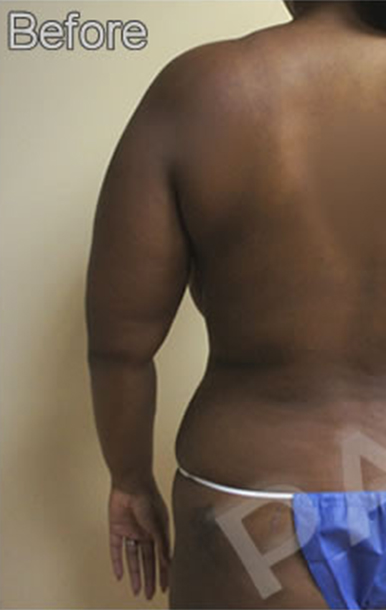 Procedure before and after - before