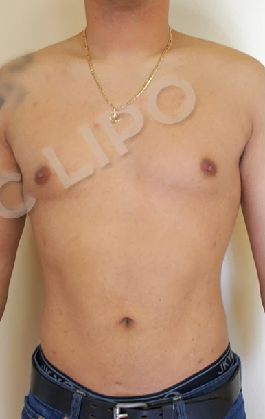 Procedure before and after - after