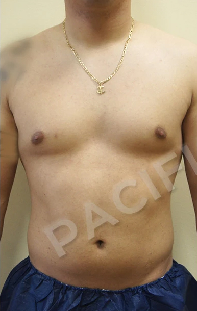 Procedure before and after - before