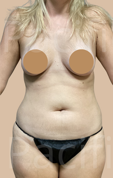 Procedure before and after - before