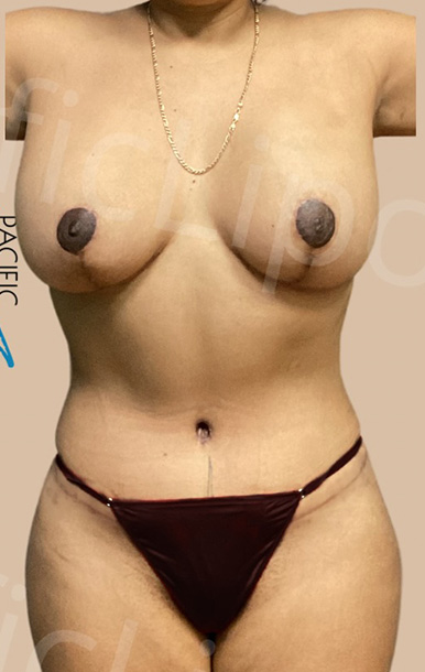 Procedure before and after - after