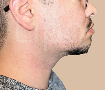 Procedure before and after - after