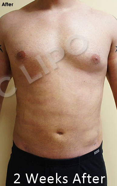 Procedure before and after - before