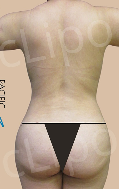 Procedure before and after - after