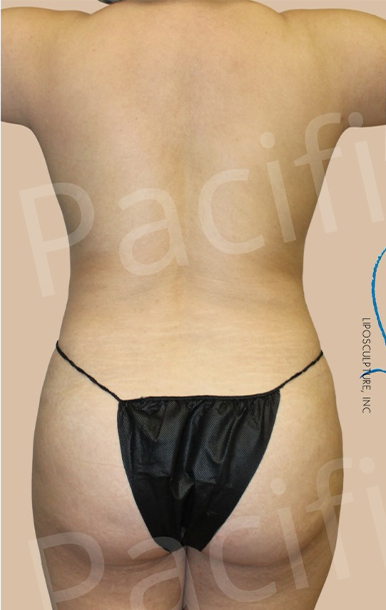 Procedure before and after - before