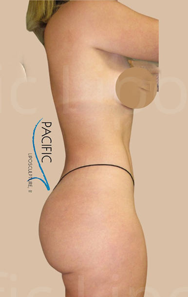 Procedure before and after - after