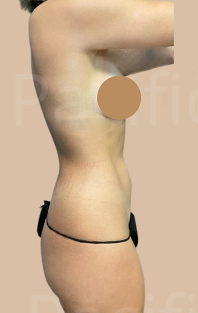 Procedure before and after - before