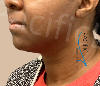 Procedure before and after - after