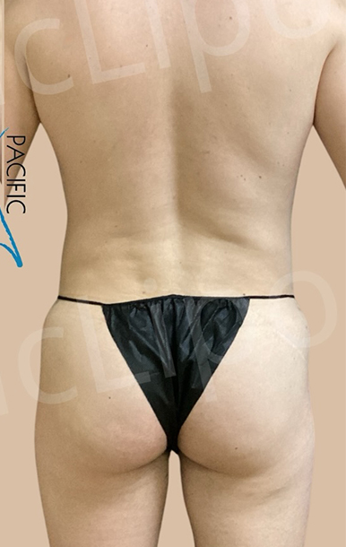 Procedure before and after - after