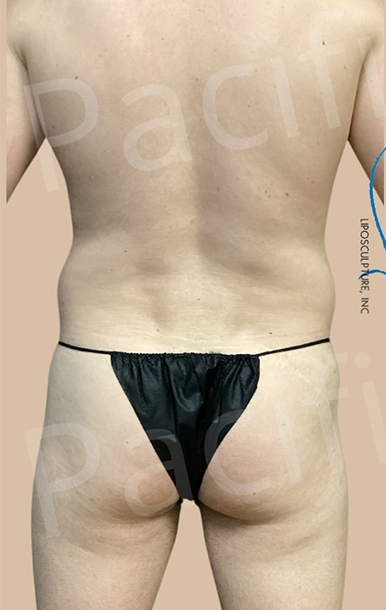 Procedure before and after - before