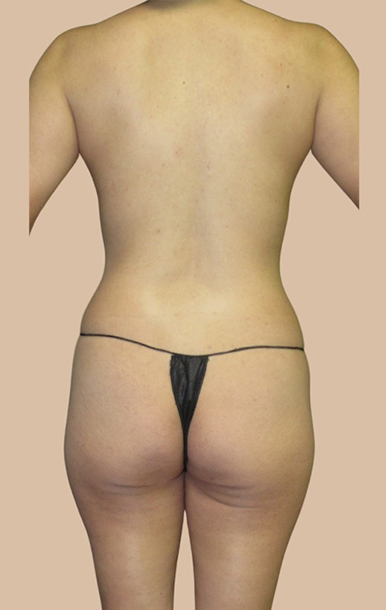 Procedure before and after - before