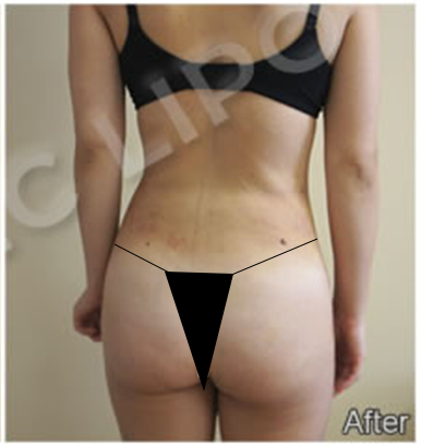 Procedure before and after - after
