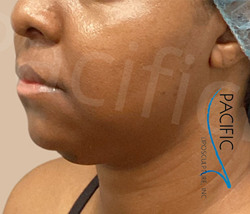 Procedure before and after - before