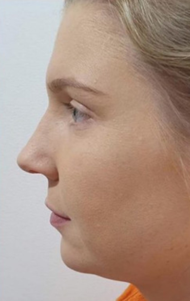 Procedure before and after - after