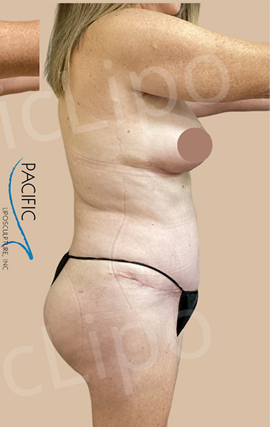 Procedure before and after - after