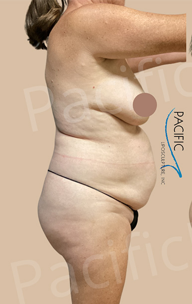 Procedure before and after - before