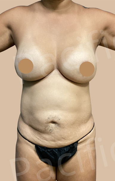 Procedure before and after - before