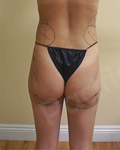 Procedure before and after - before